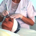 Micro Needling Behandlung